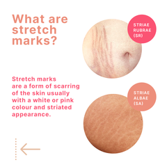 STRIANIX-W White Stretch Marks Removal Cream 50g
