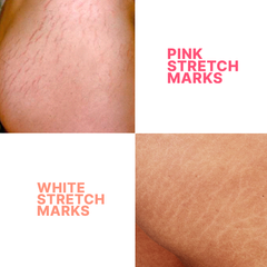 STRIANIX-W White Stretch Marks Removal Cream 50g