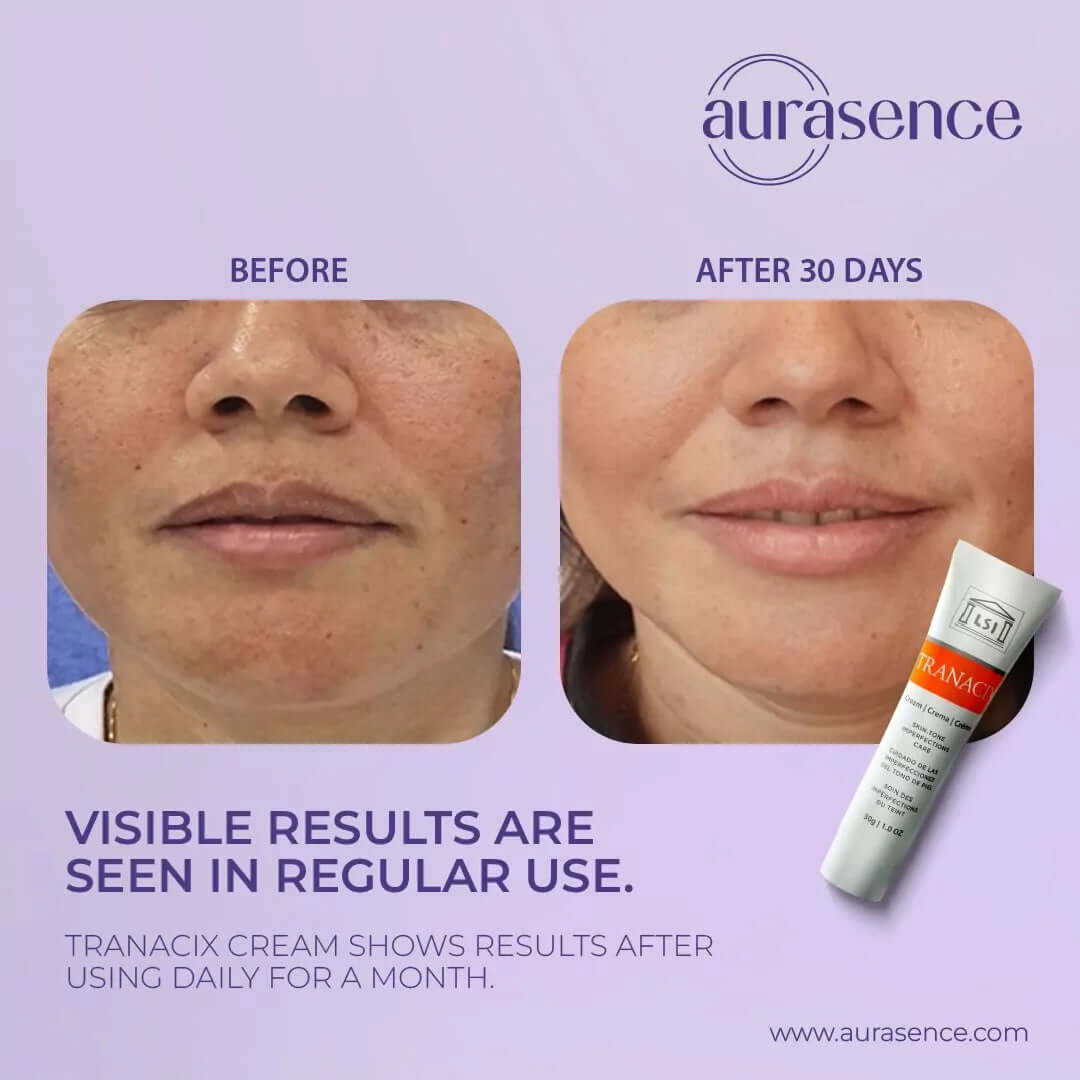 Tranacix Cream 30g in UAE –Before and After – Aurasence