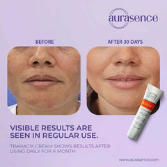 Tranacix Cream 30g in UAE –Before and After – Aurasence