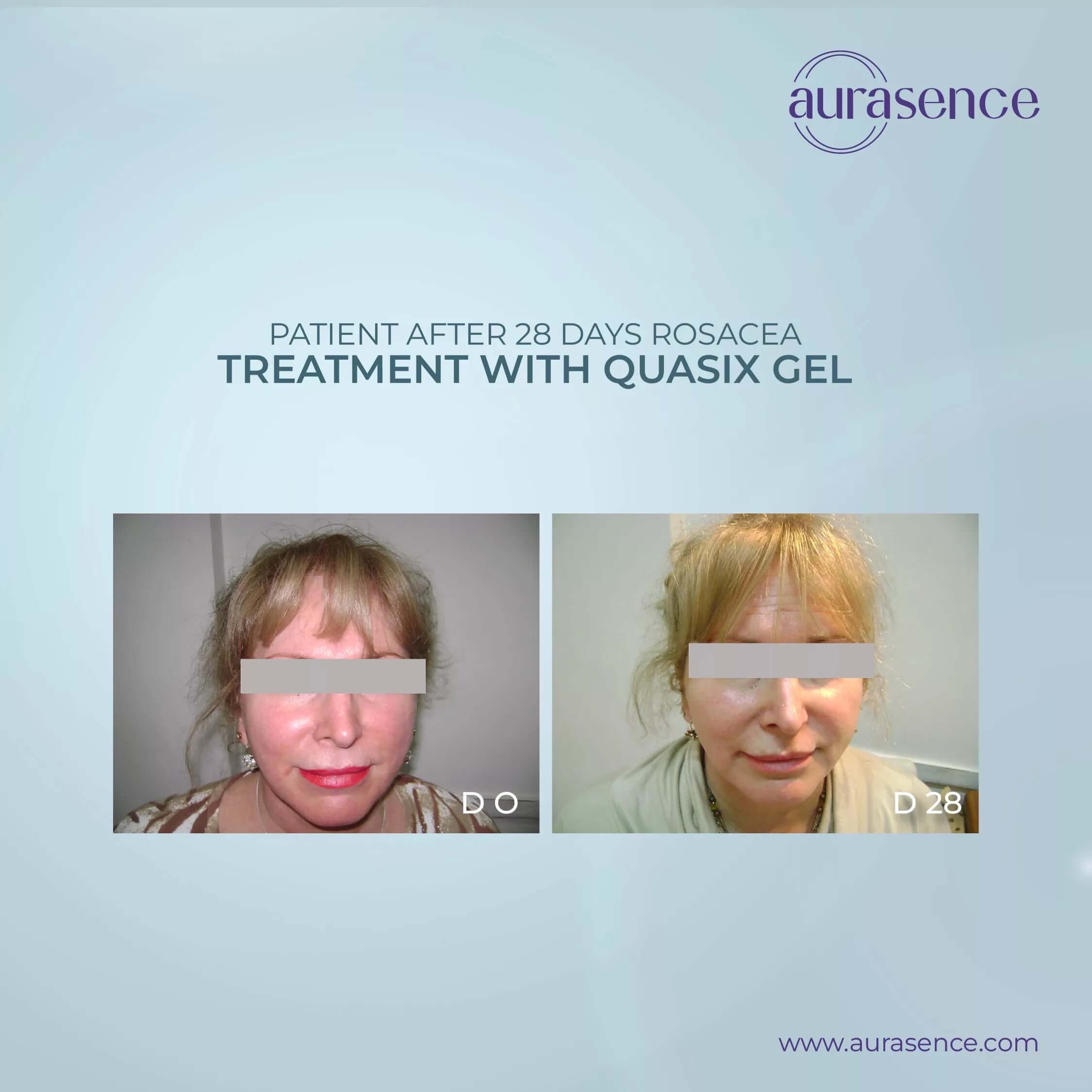 Quasix Gel 30ml Pack in UAE | Patients after 28 Days Rosacea | Aurasence
