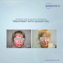 Quasix Gel 30ml Pack in UAE | Patients after 28 Days Rosacea | Aurasence