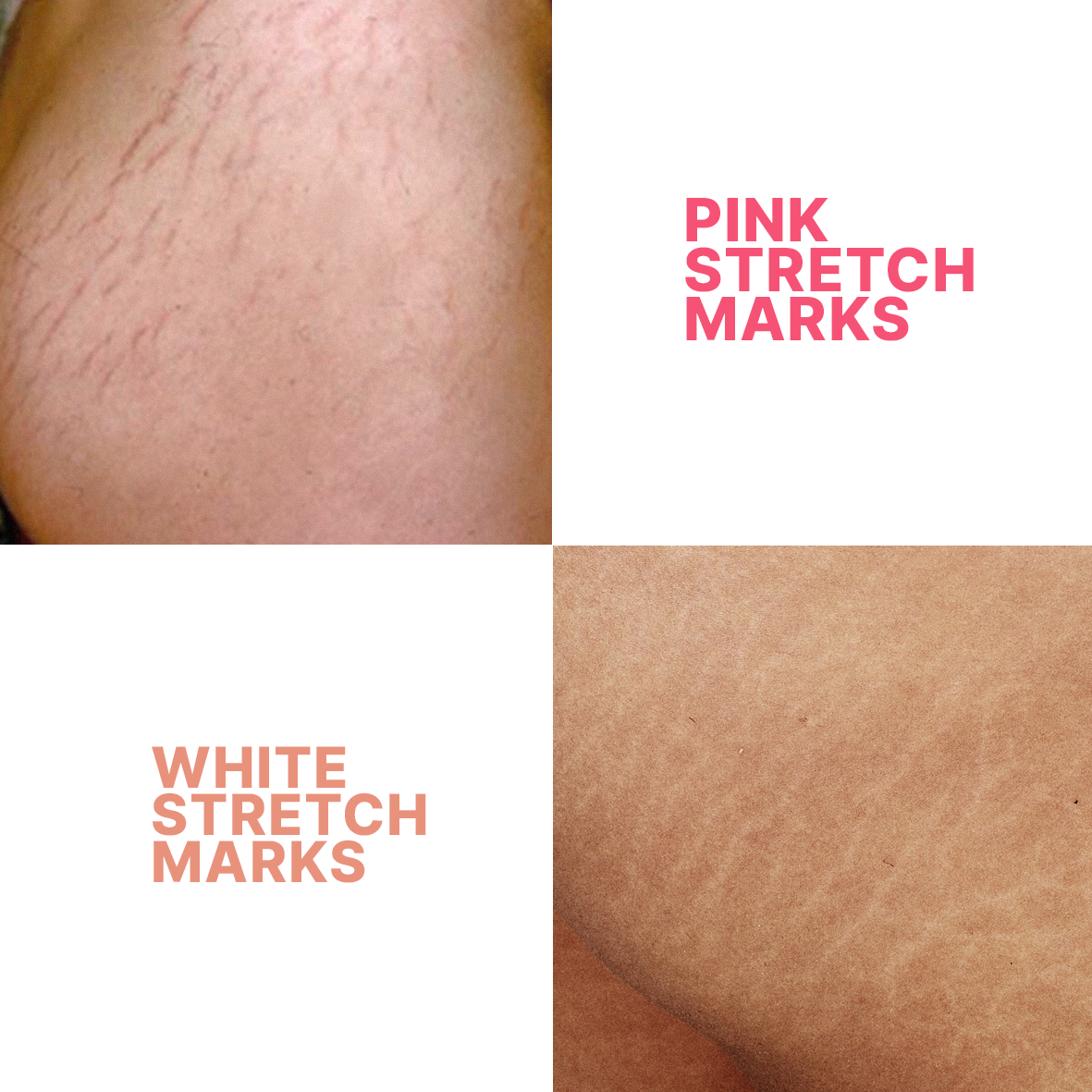 STRIANIX-P Pink Stretch Marks Removal Cream 50g