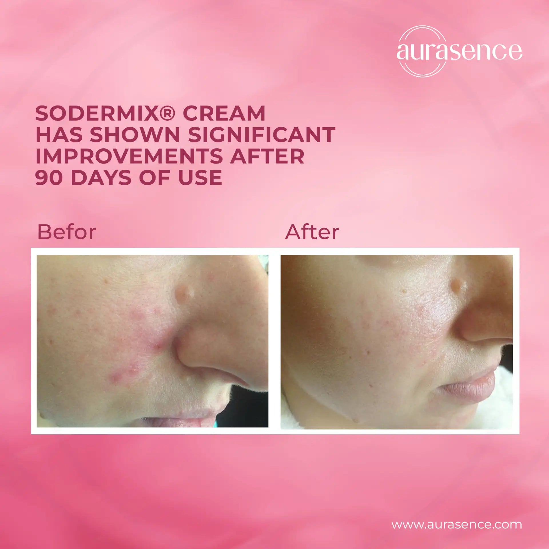 SODERMIX Cream 15ml