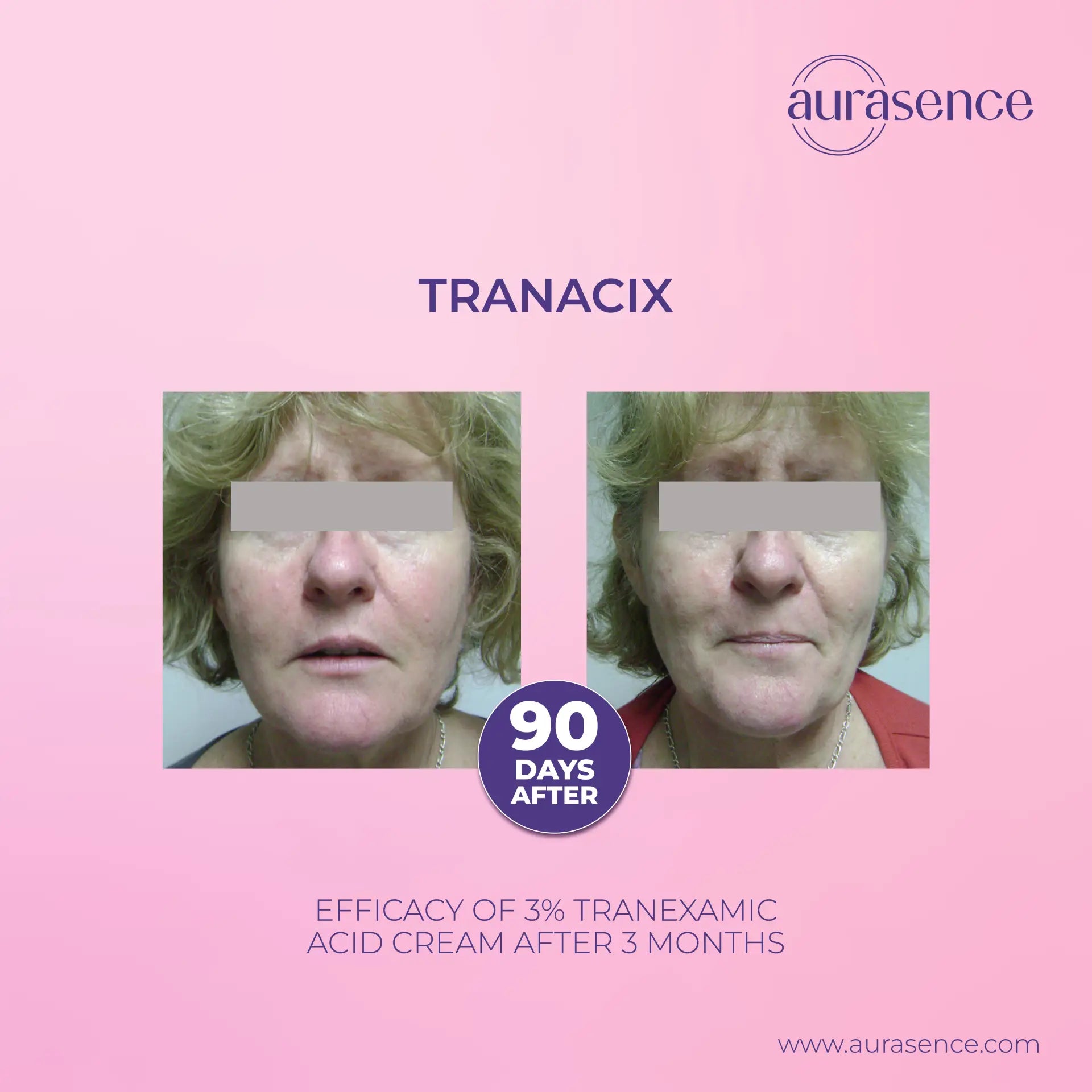 TRANACIX®  Skin Tone Imperfections Care Cream with 3% Tranexamic acid | Reduces Melasma | Fades dark spots  – 30g